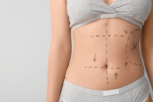 Liposuction: Technology-Driven Precision