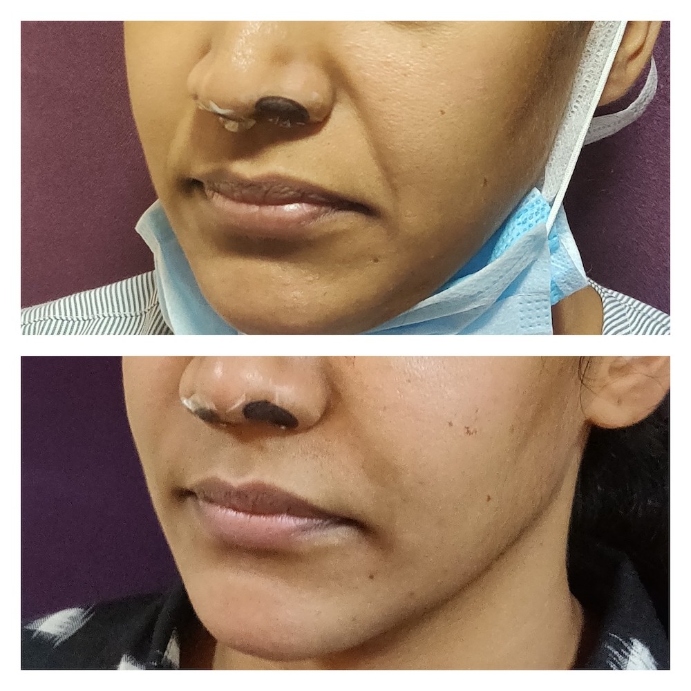 Facial Fat Grafting in Mumbai