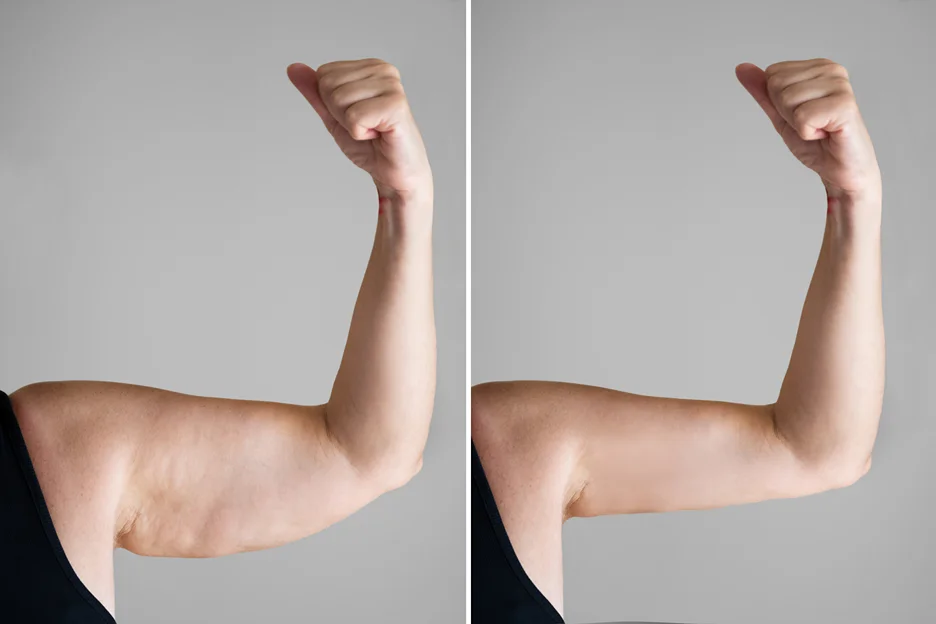 Arm lift recovery procedure