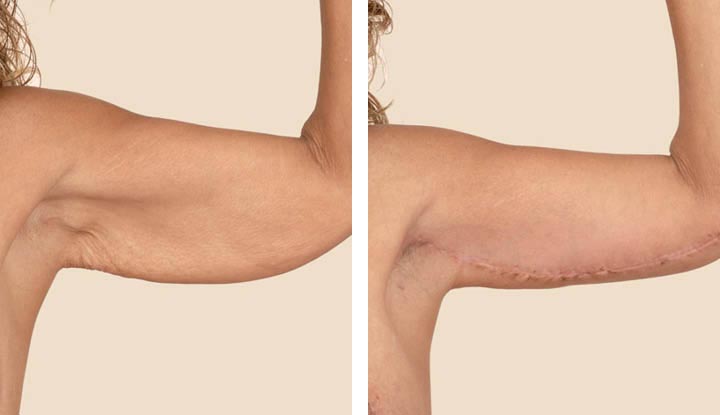 What is Arm Lift Surgery?