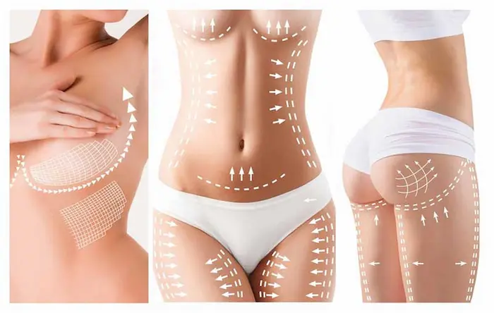What is Body Lift Surgery