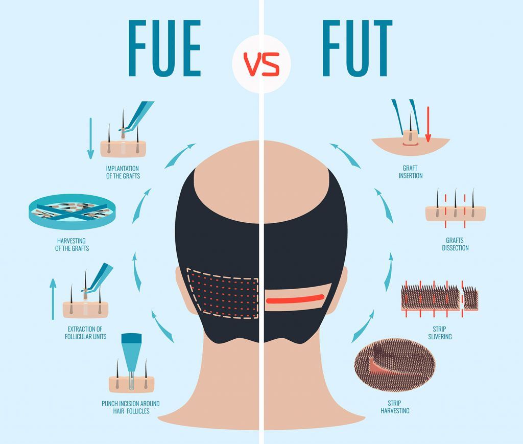 Hair Transplant Techniques