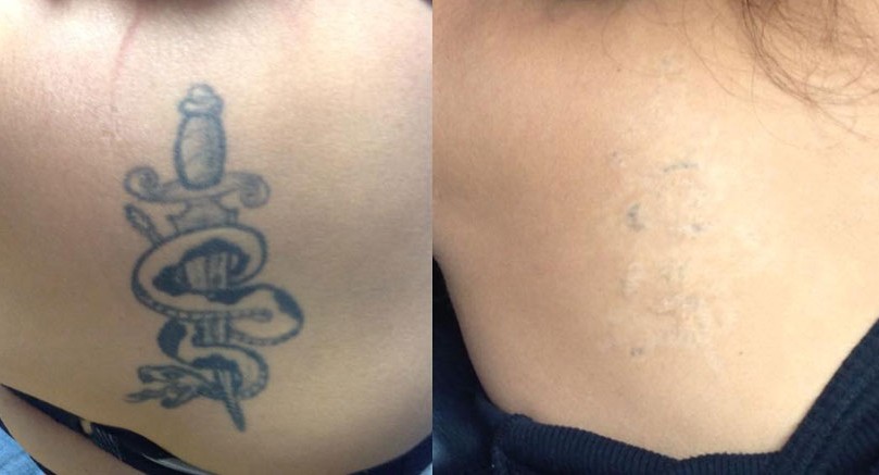 Understanding Laser Tattoo Removal