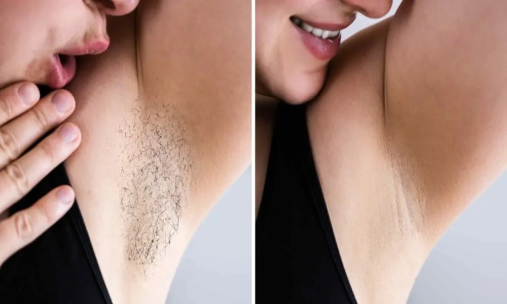 Understanding Laser Hair Removal for Sensitive Areas