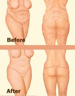 Body lift Before after