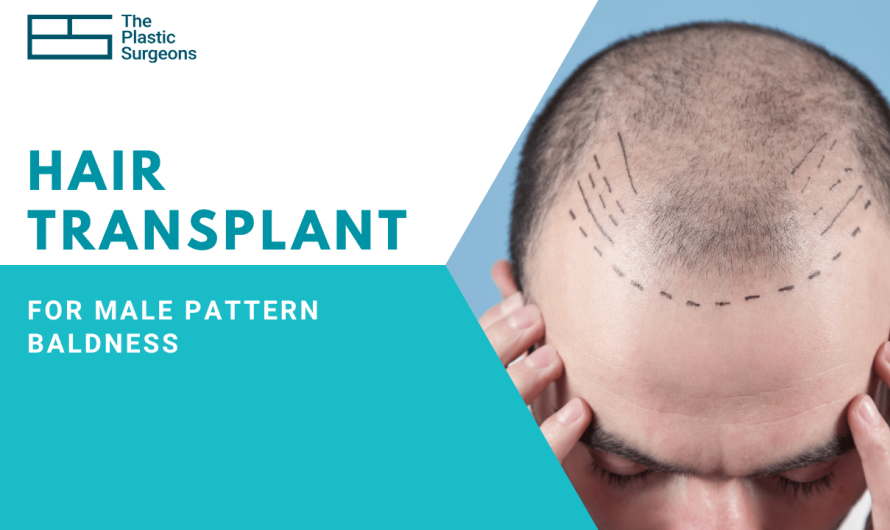 Hair Transplant for Male Pattern Baldness