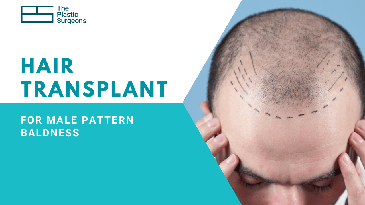 Hair Transplant for Male Pattern Baldness