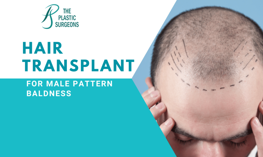 Hair Transplant for Male Pattern Baldness