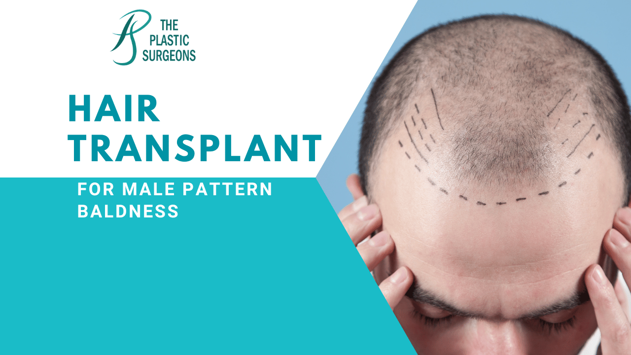 Hair Transplant for Male Pattern Baldness