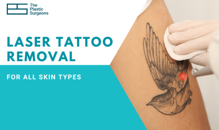 How Safe is Laser Tattoo Removal for All Skin Types?