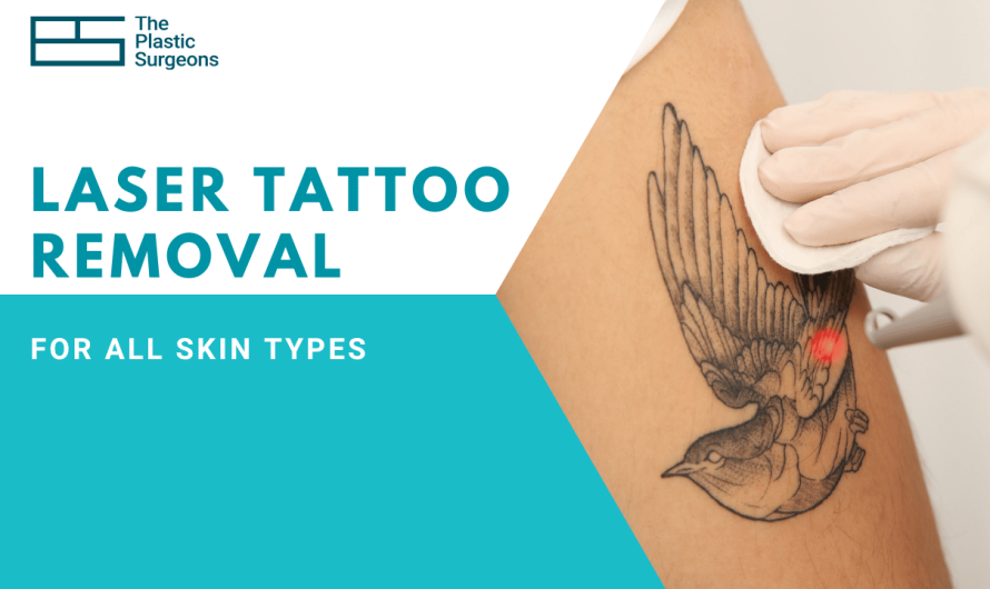 How Safe is Laser Tattoo Removal for All Skin Types?