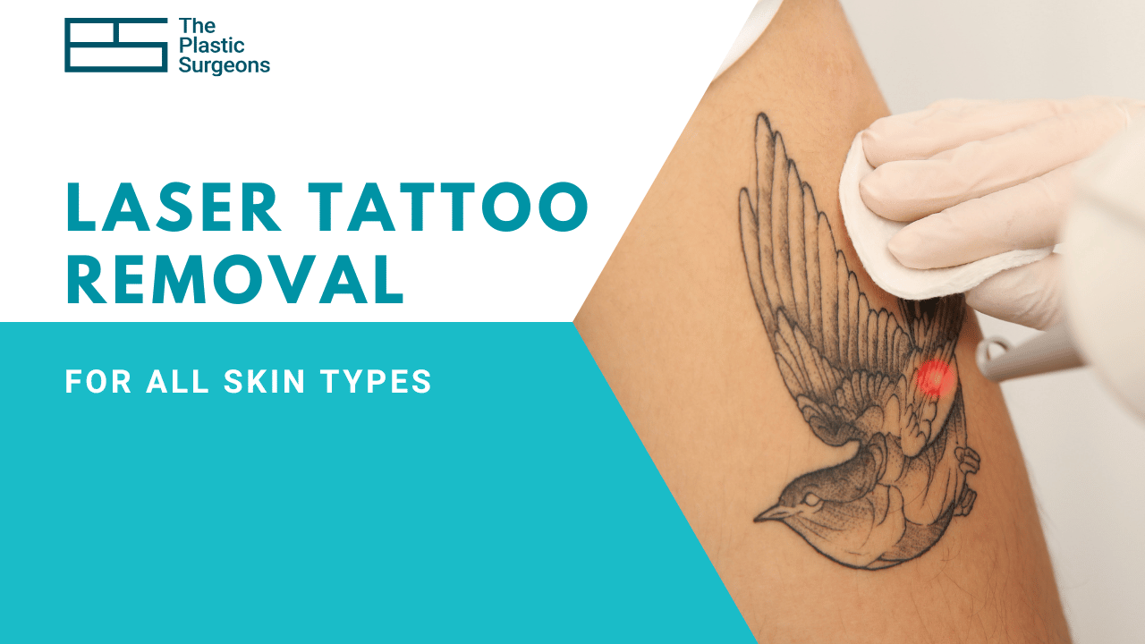 How Safe is Laser Tattoo Removal for All Skin Types?