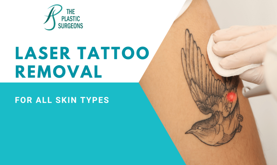 How Safe is Laser Tattoo Removal for All Skin Types?