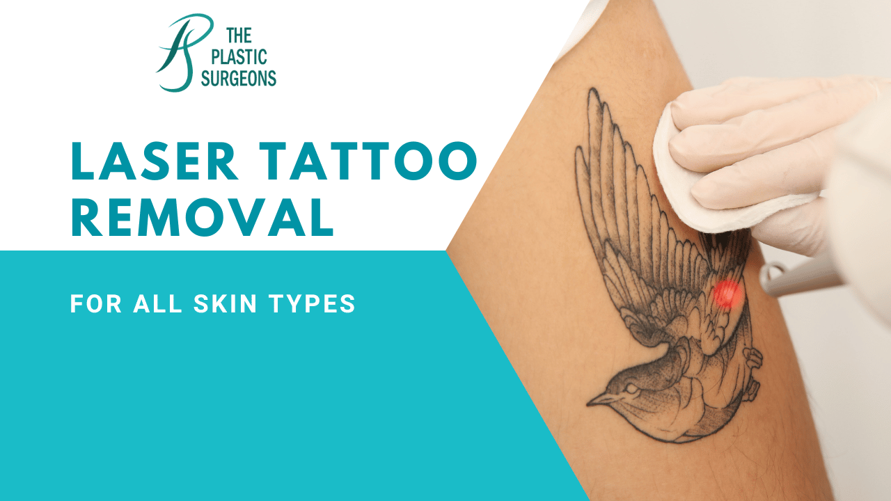 How Safe is Laser Tattoo Removal for All Skin Types?