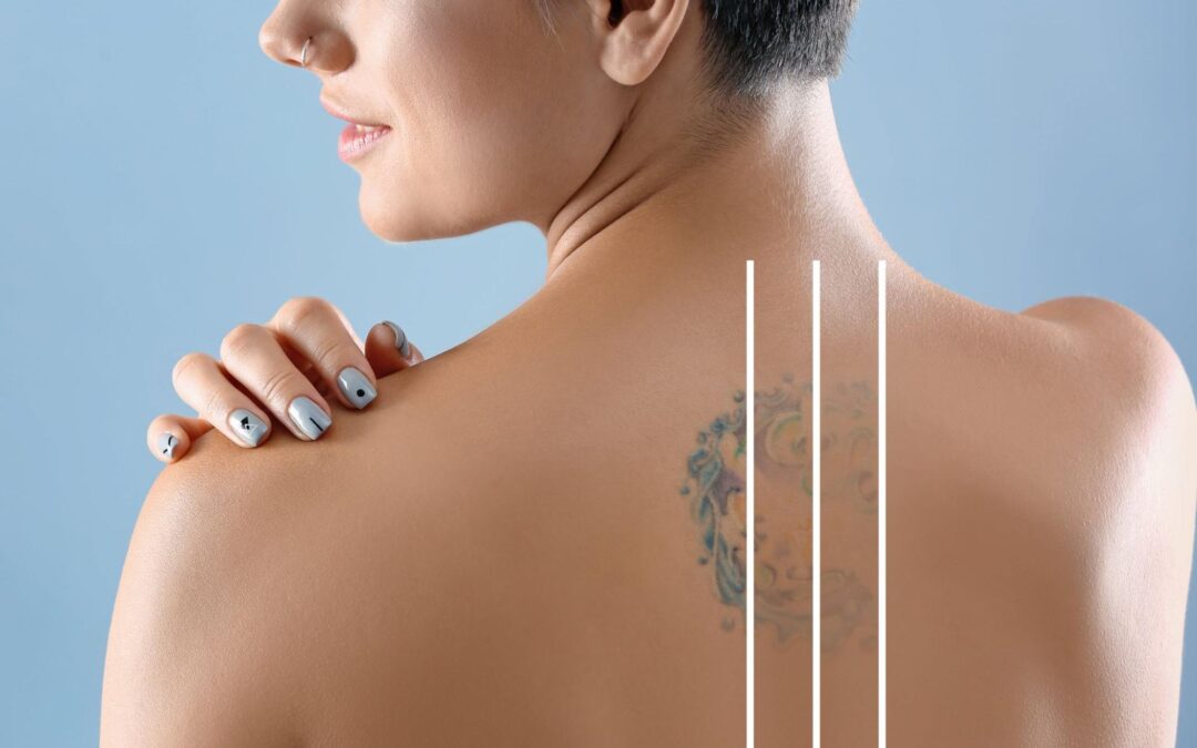 Pre-Treatment and Post-Treatment Care for Laser Tatoo Removal