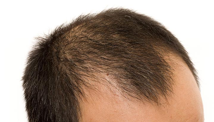 Understanding Male Pattern Baldness
