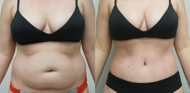 What Is Liposuction?