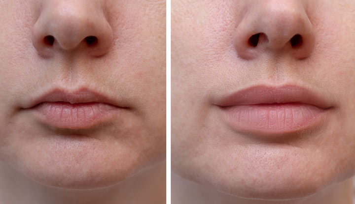 Benefits of Lip Augmentation