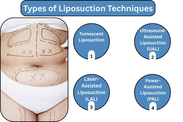 Types of Liposuction Techniques