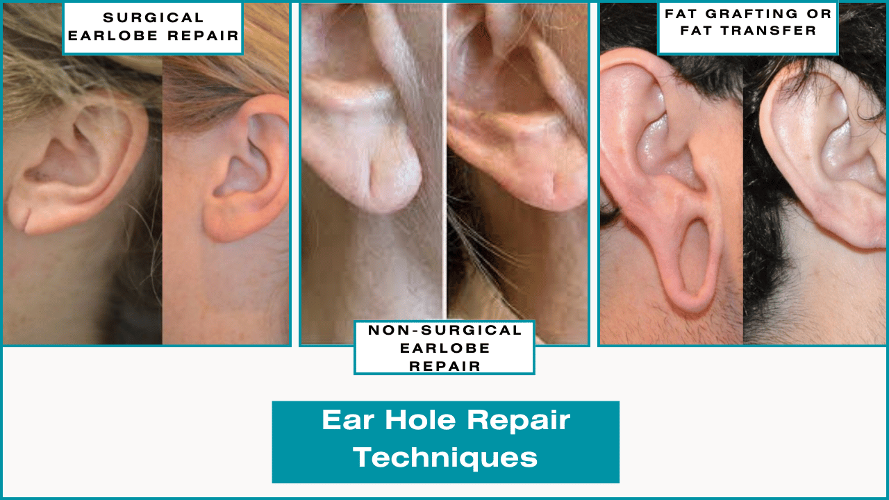 Popular Ear Hole Repair Techniques