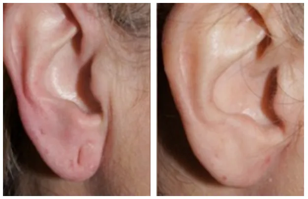 Precautions to Take After ear lobe Surgery
