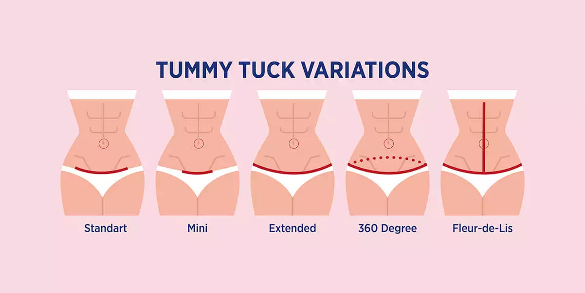 tummy tuck surgery
