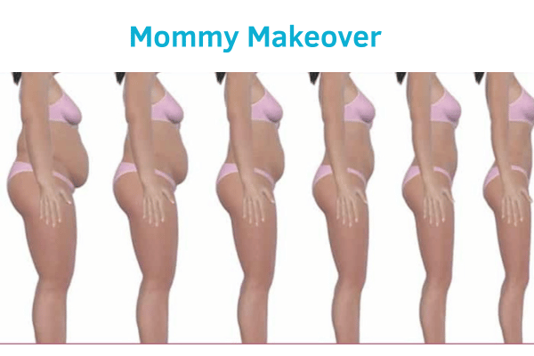 Mommy Makeover
