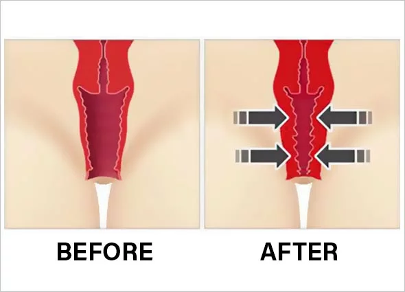 vaginal rejunvation