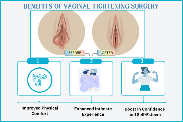 Benefits of Vaginal Tightening Surgery