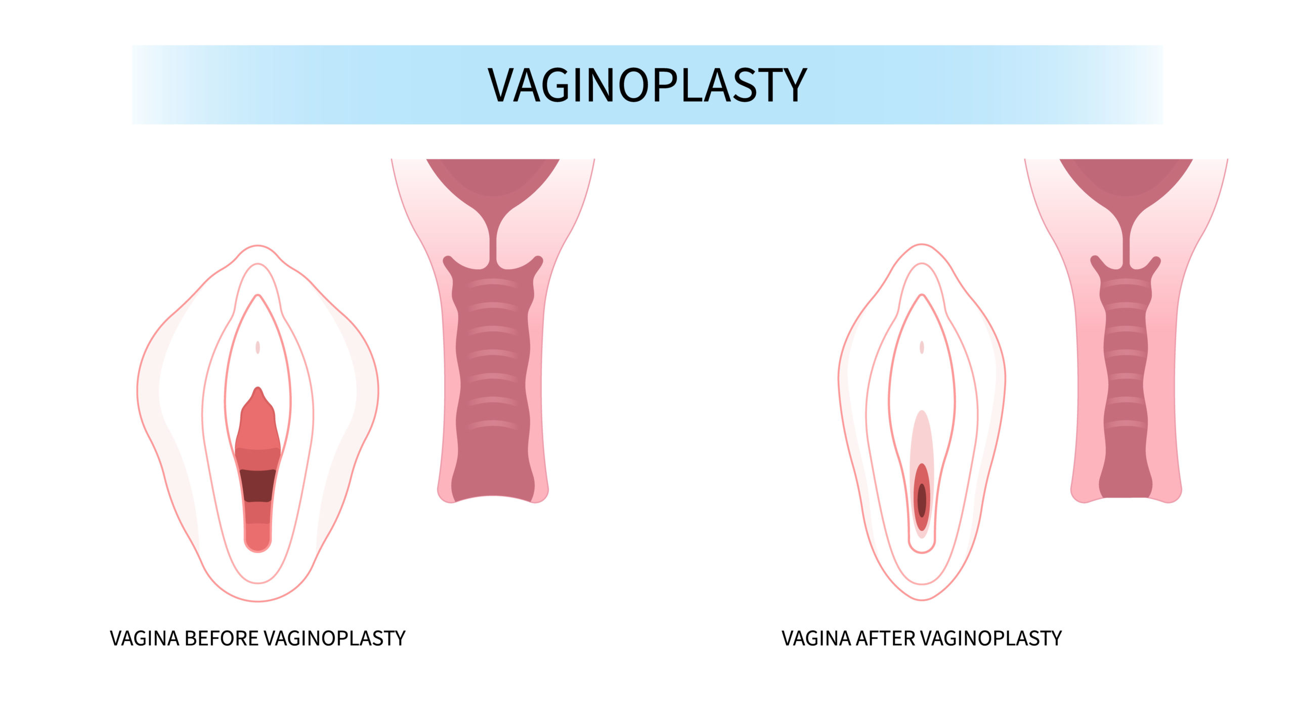 Vaginal Tightening Surgery in mumbai