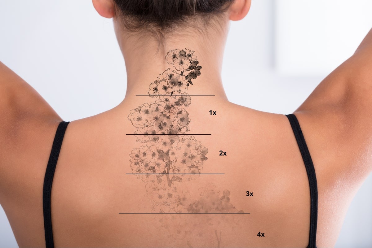 factors-affecting-tattoo-removal-cost