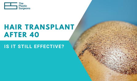 Hair Transplant After 40: Is It Still Effective?