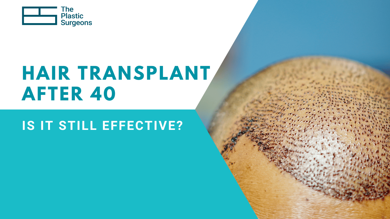 Hair Transplant After 40: Is It Still Effective?