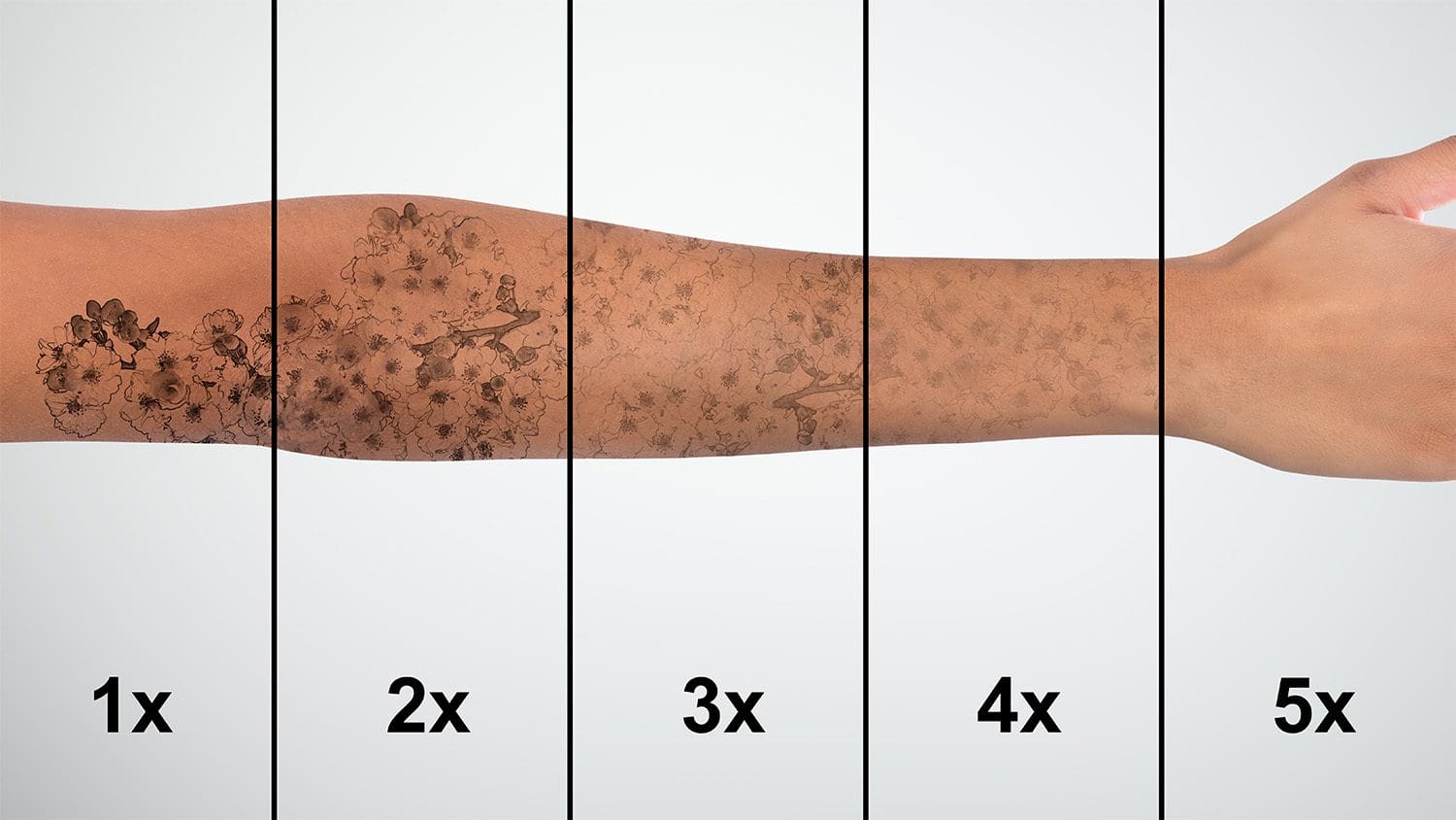 Duration of Tattoo Removal: What You Need to Know