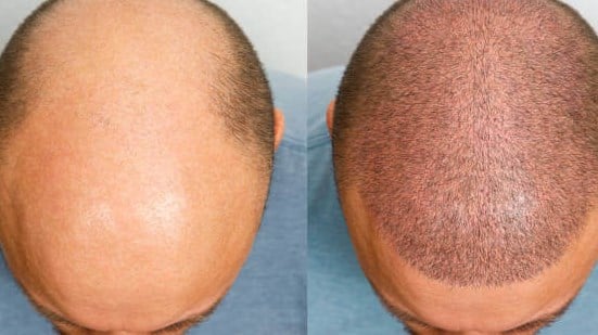 Types of Hair Transplant Techniques