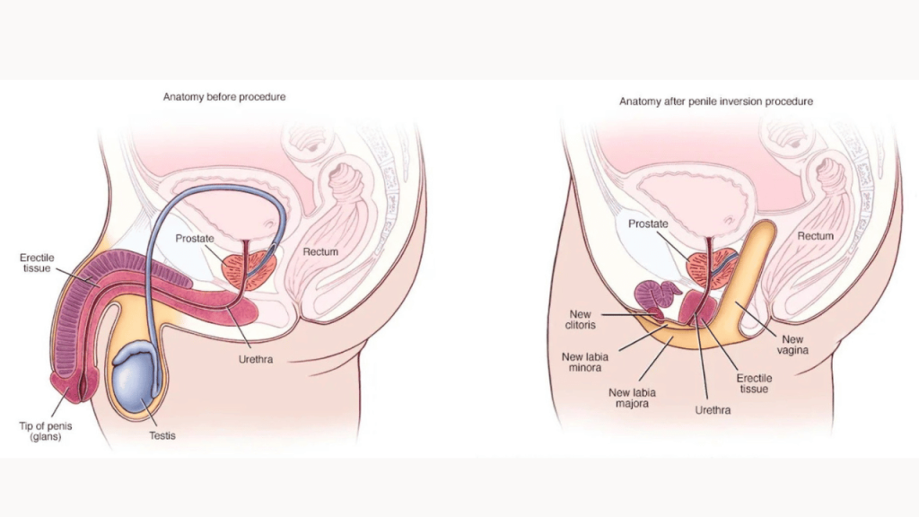 Why Gender Reassignment Surgery is Key in Transgender Care - The