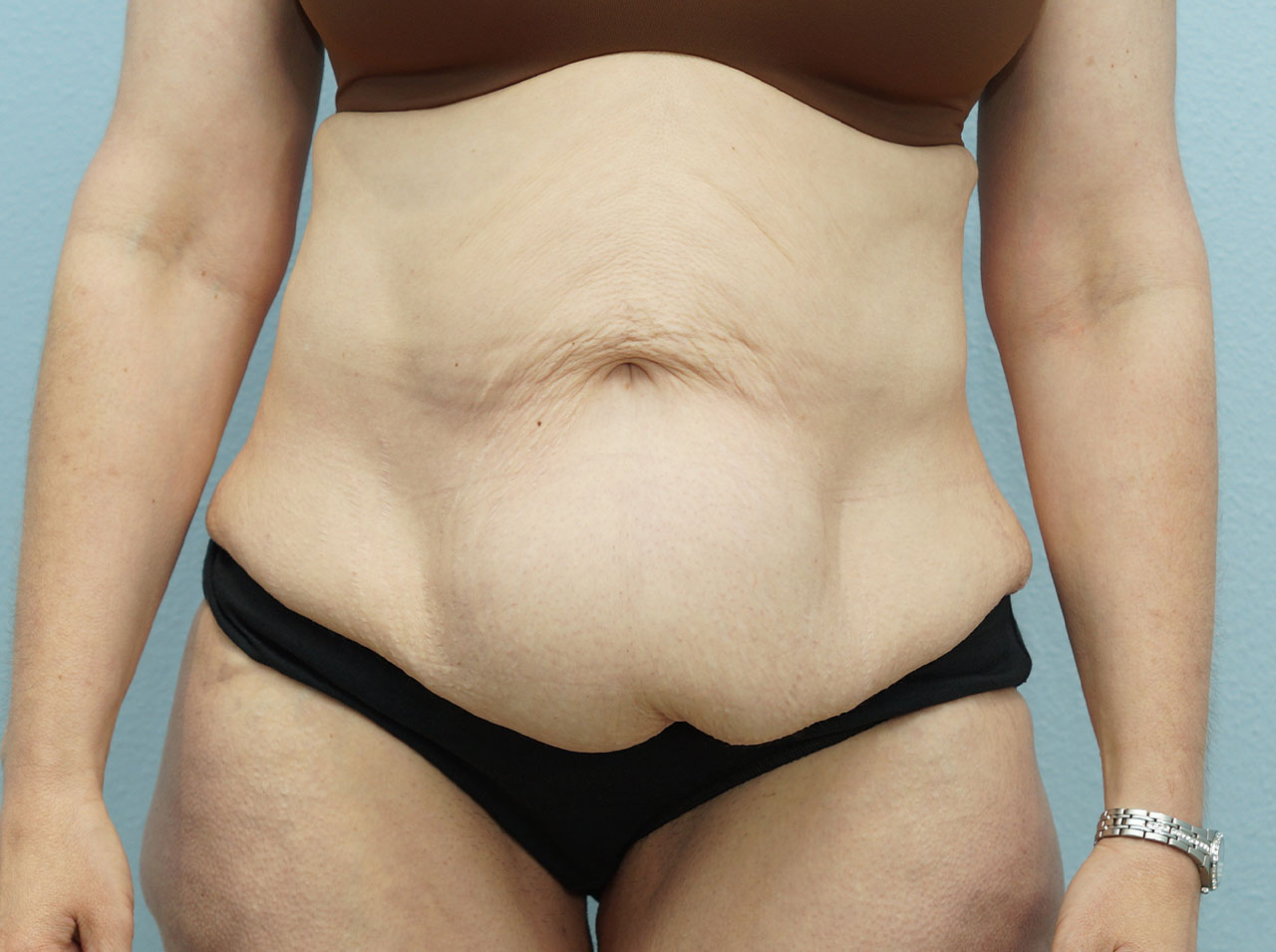Who Is a Good Candidate for Body Lift Surgery?