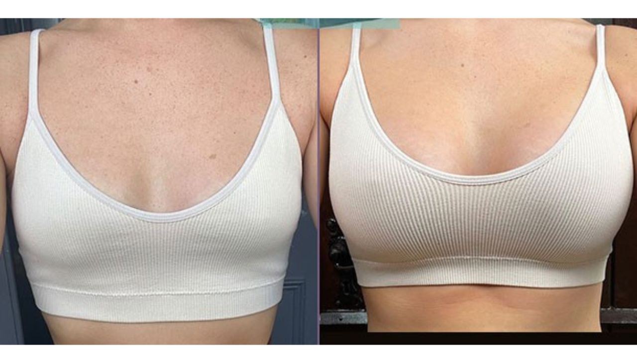 breast implant