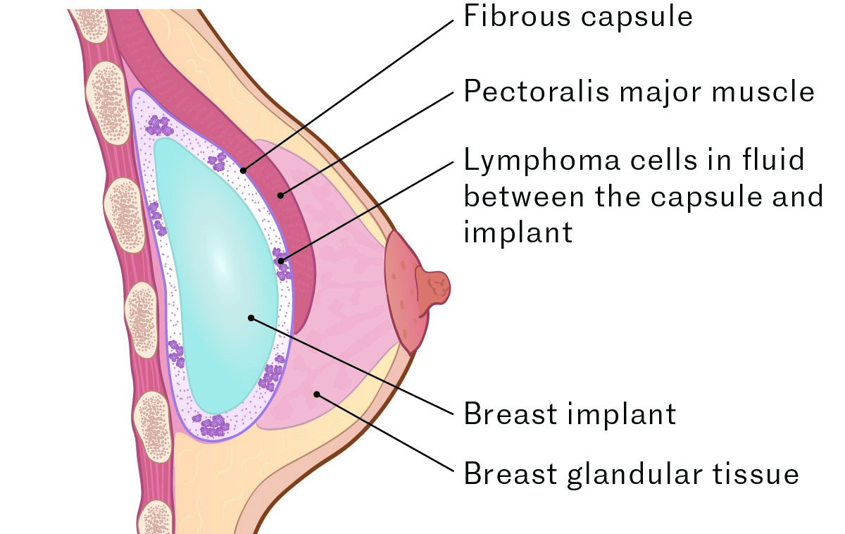 Breast Implant-Associated Anaplastic Large Cell Lymphoma (BIA-ALCL)