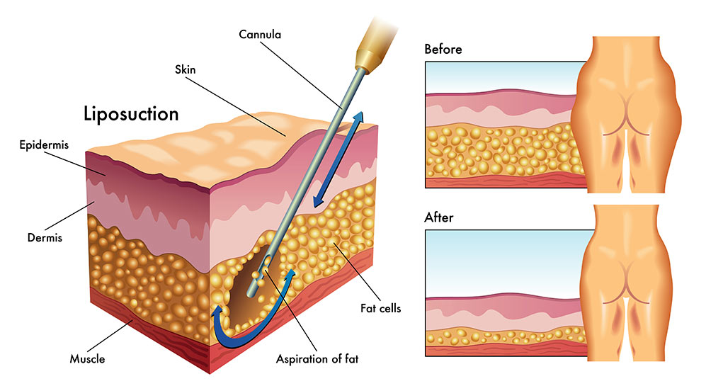 How Liposuction Works