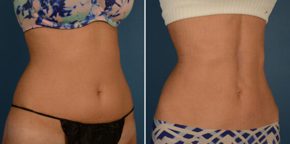 Maintaining Results from Liposuction