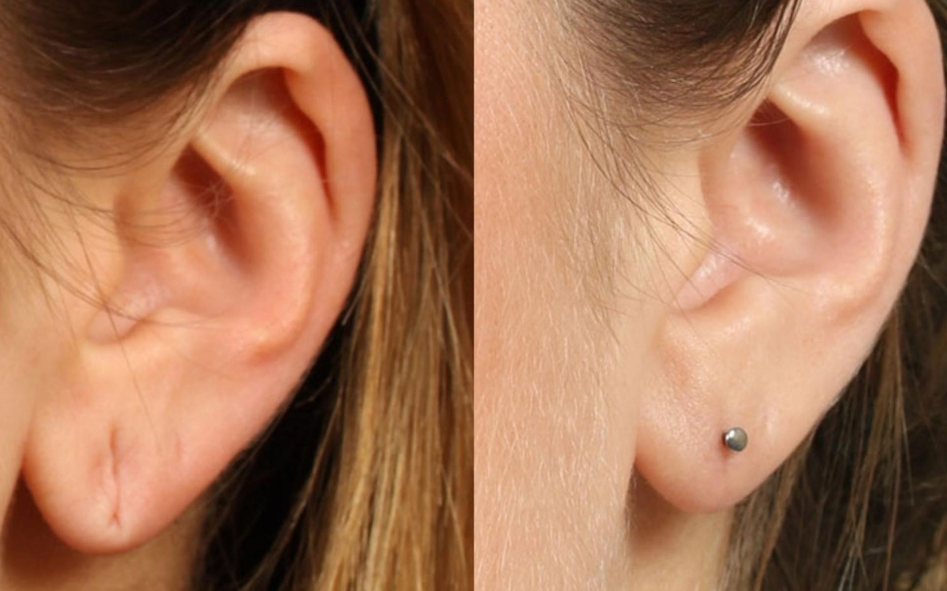 What Is Ear Lobe Repair Surgery?