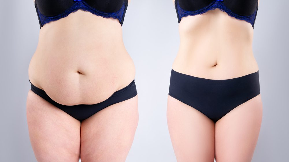 What Is Liposuction and How Does It Work?