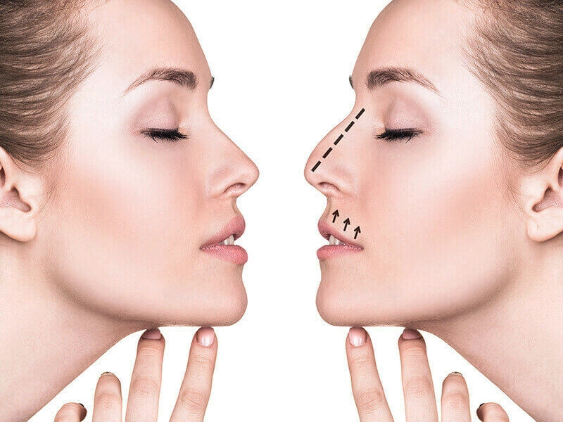 What Rhinoplasty Involves