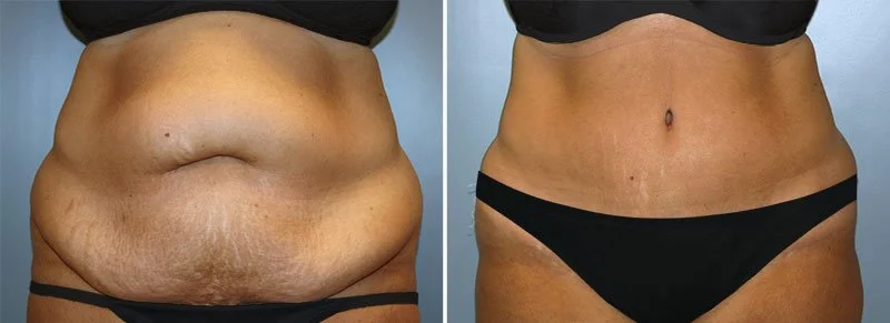 What Is a Tummy Tuck Procedure?