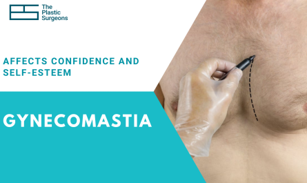 how-gynecomastia-treatment-can-improve-confidence-self-esteem