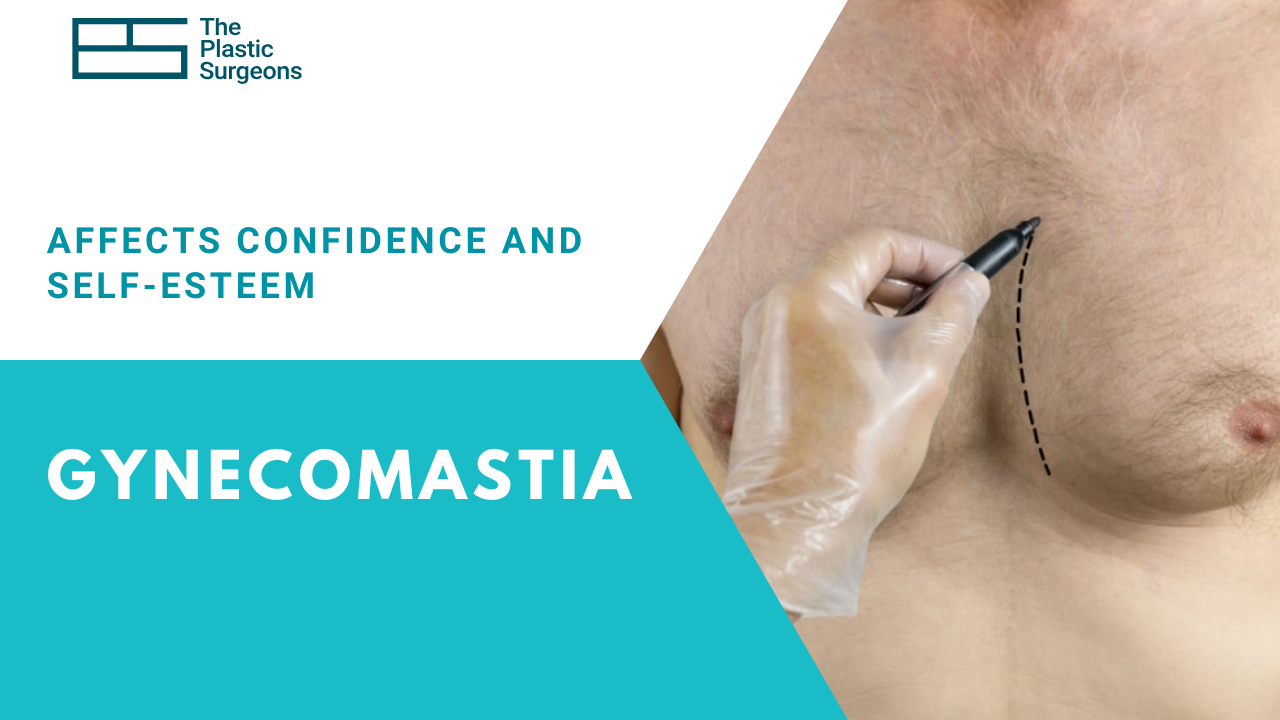 how-gynecomastia-treatment-can-improve-confidence-self-esteem