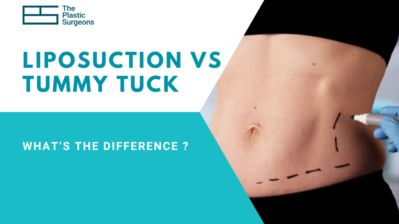 liposuction-vs-tummy-tuck