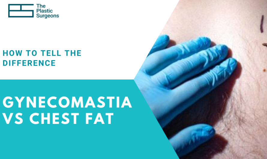Gynecomastia vs Chest Fat: How to Tell the Difference