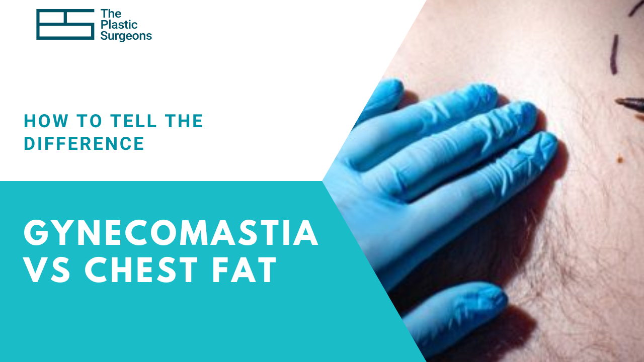 gynecomastia-vs-chest-fat-how-to-tell-the-difference